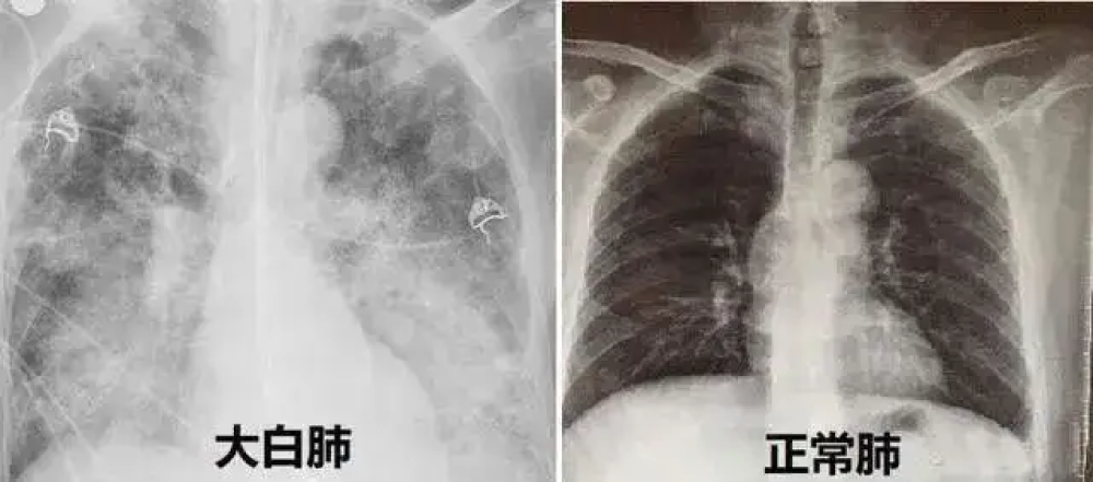 “阳康”并非是痊愈的开始，医生提醒，出现这类症状请及时CT检查 鹿血片 第1张